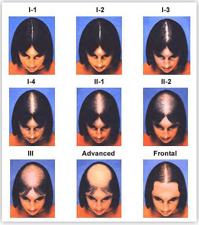 Female pattern baldness Information  Mount Sinai  New York